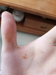 橙色斑,手上突然有橙色斑,不痛不痒