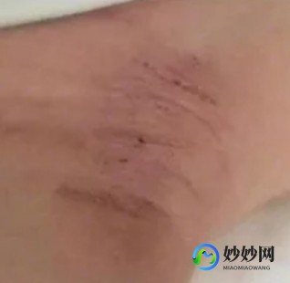腋下臭可以手术吗,腋下臭可以手术吗