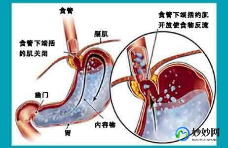 反酸烧心食管反流吃什么药,治疗反酸烧心反流性食管炎的药