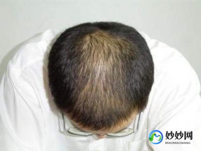 三叶草综合征,解密罕见三叶草头综合症,健康科普