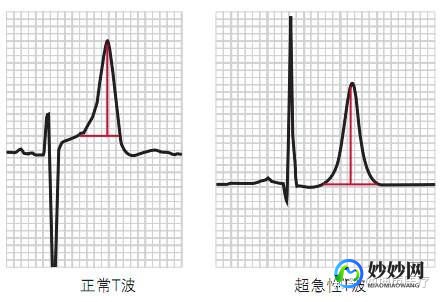 v2v3v4抬高,轻度ST段抬高V2V3V4严重吗田洪波