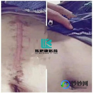 隐疤乐,揭秘隐疤乐效果如何