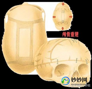 矢状缝早闭,矢状缝过早闭症状有什么