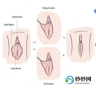 11岁孩子正常阴脣有几瓣,正常的是什么样的