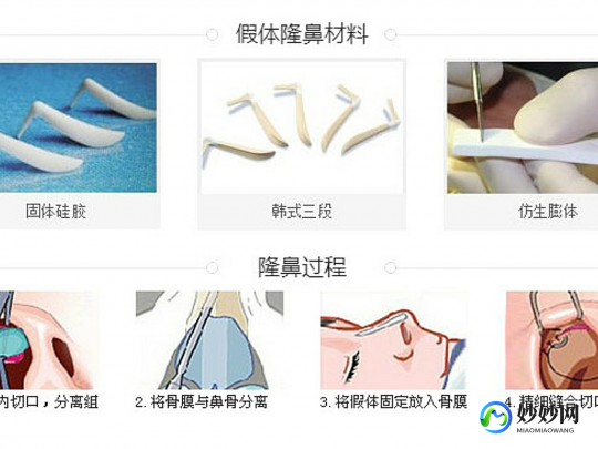 隆鼻材料,隆鼻材料有哪些