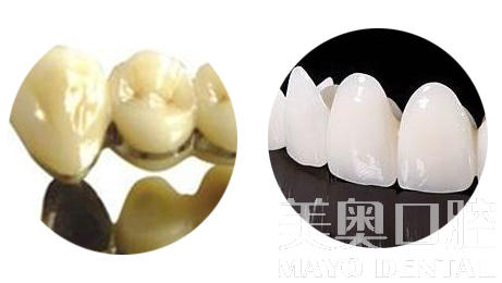 烤瓷牙用什么材料好,烤瓷牙用什么材料好