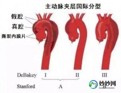 急性大动脉解离,急性主动脉分离啥意思