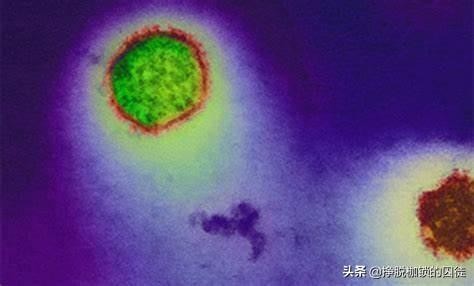 汉坦病毒症状,汉坦病毒有什么症状