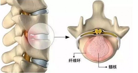 洛索洛芬钠片的功效与作用,洛索洛芬钠片的功效与作用