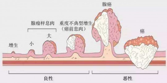 肠息肉的主要症状有哪些,肠息肉的主要症状有哪些