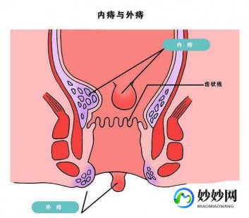 痔疮是什么样子,痔疮什么样的