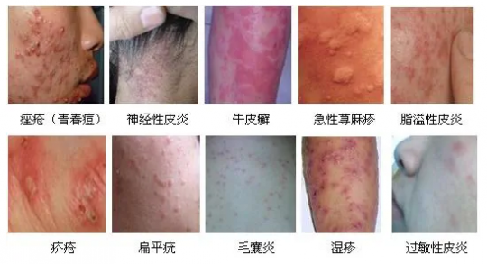 神经性皮炎吃什么药,治疗神经性皮炎的药有哪些