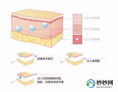 玻尿酸效果,玻尿酸有哪些功效