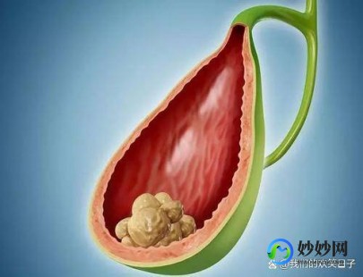 胆囊结石用什么药,胆结石要吃什么药
