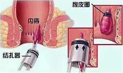 内痔吃什么药,内痔疮吃什么药
