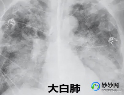 白肺最怕三个征兆,老人白肺最怕三个征兆