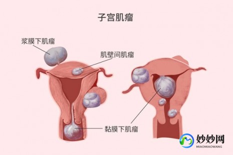 子宫肌瘤切除手术后怀孕的影响与注意事项解析