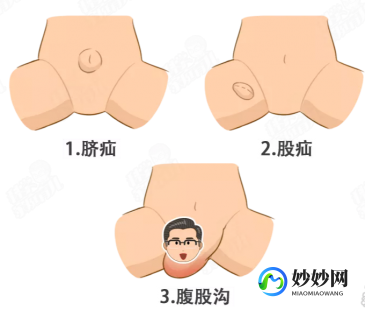 股疝,股疝_股疝的症状_股疝治疗方法_股疝用药_疾病百科