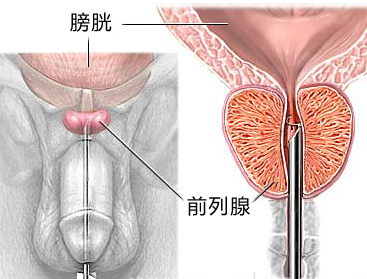 前腺,前列腺肥大是什么