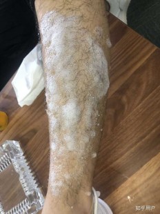 男性脱毛,男士怎么脱毛