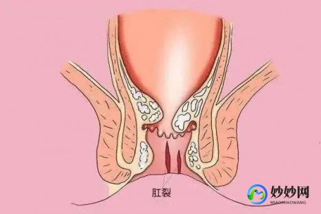 肛裂会出血吗,肛裂大便会出血吗