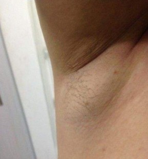 腋下淋巴结要紧吗,腋下有淋巴结严重吗