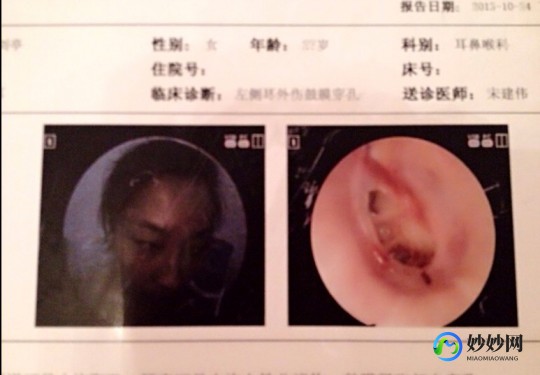 外伤性鼓膜穿孔,耳外伤导致的耳膜穿孔怎么办
