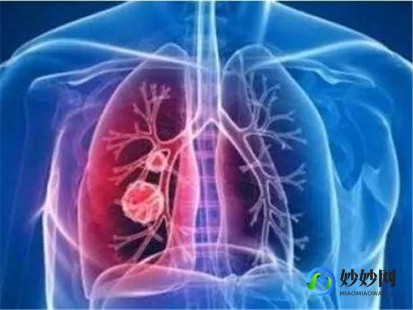 肺气肿感染新冠肺炎会怎么样,肺气肿患者感染新冠会怎样