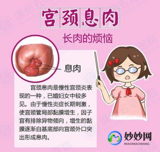 颈息肉,子宫颈息肉严重吗