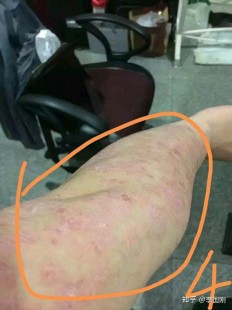 大连治疗牛皮癣,大连牛皮癣医院_大连治疗牛皮癣医院哪家好_大连牛皮癣医院...