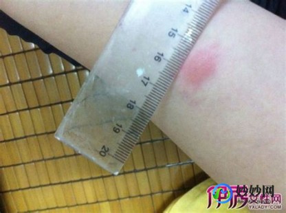 卡介苗皮试,卡介苗皮试多久看结果