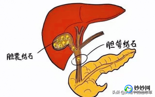 胆囊结石中药能排出吗,胆囊结石中药能排出吗