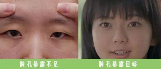 单眼皮,单眼皮的原因有哪些