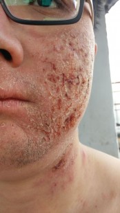 瘙痒症,口特别痒
