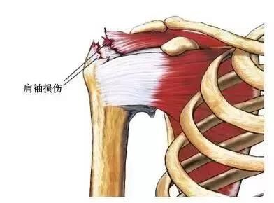 肩膀内扣是什么梗,揭秘肩膀内扣梗背后的真相与改善方法,肩膀内扣严重怎么办