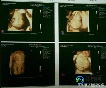 孕囊形状看男女,B超单看男女方法盘点-孕囊大小、形状一看便知