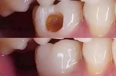 牙髓炎可以补牙吗,牙髓炎能补牙吗