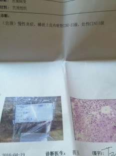 CIN2病变是什么意思,cin2级是什么意思