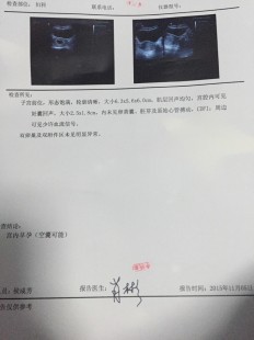 空囊是什么意思,空孕囊是什么原因造成的