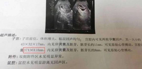nt值看男女,nt数值看性别的窍门,厚度1.5mm揭秘*宝女宝的可能性!