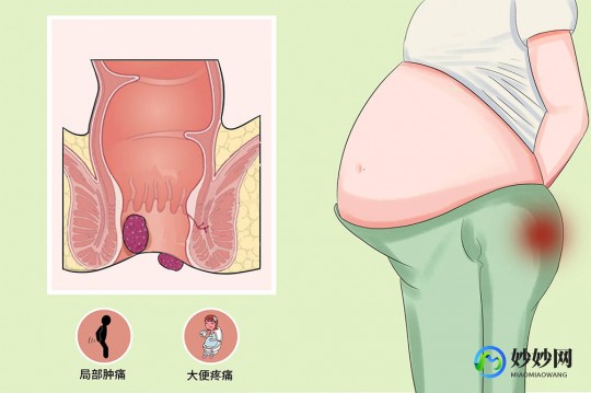 产后得了痔疮怎么办,顺产有痔疮怎么好得快