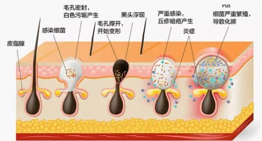 黑头会自己消失吗,黑头不去挤会自己好吗？