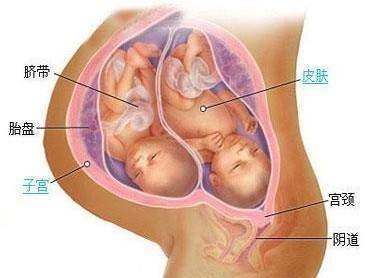 双胎能顺产吗,双胎能顺产吗