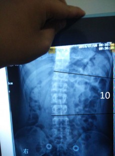 脊柱侧弯能当兵吗,脊柱侧弯体检能过吗