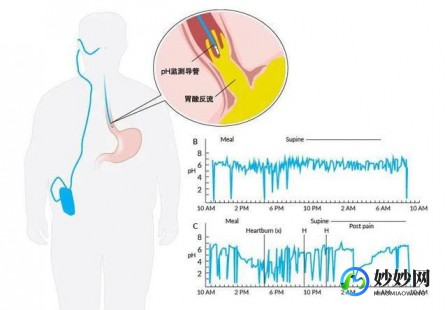 导管相关血流感染,导管相关性血流感染诊断标准