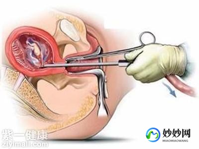 什么是人流,做人流是什么意思