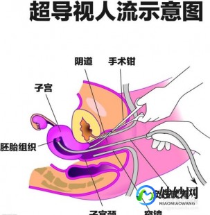什么是人流,做人流是什么意思