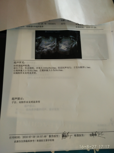 宫外孕流产,宫外孕自然流产