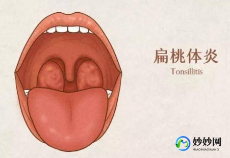 扁桃体发炎最快治疗方法,扁桃体发炎最快的解决办法是什么