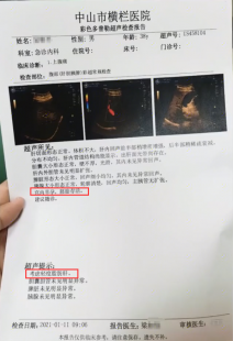 宫内早孕盆腔积液,宫内早孕盆腔积液是怎么回事